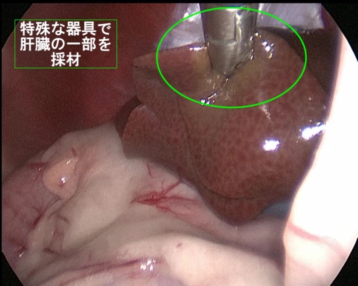 腹腔鏡手術の適応症例